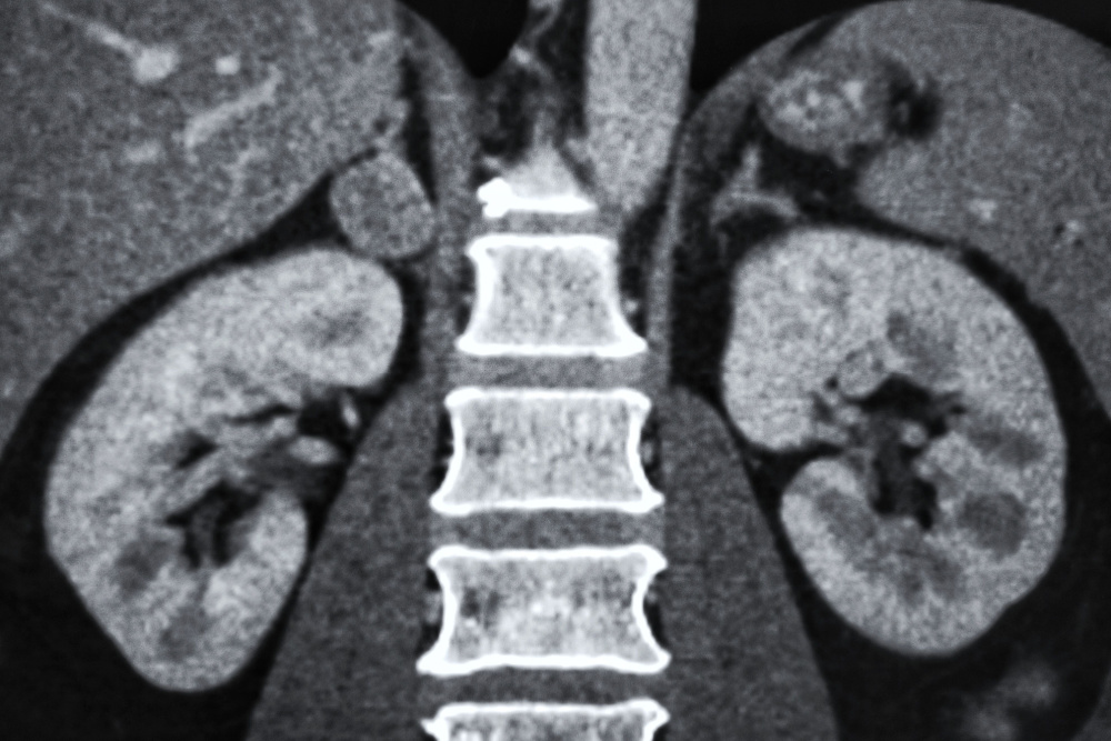 Imagem ilustrativa de nódulo na glândula adrenal