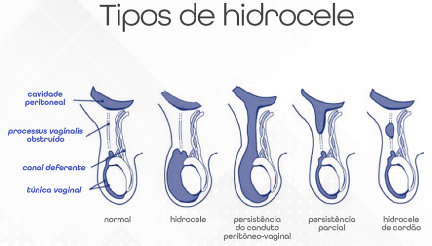 Imagem ilustrativa dos tipos de hidrocele